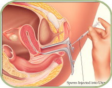 IUI procedure