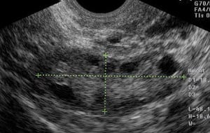 Ultrasound measurement of ovarian volume and AFC