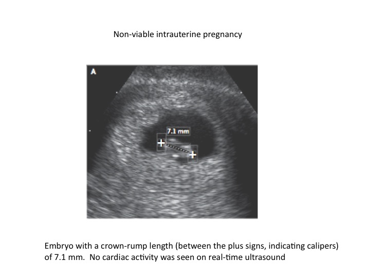Non-viable pregnancy