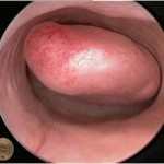 Hysteroscopic view of a polyp