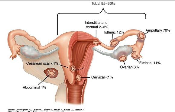 ivf and tubal pregnancy diagram