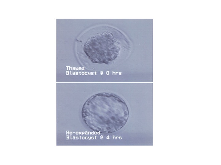 All About Thawing Frozen Embryos