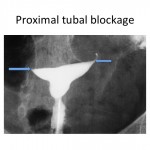 Proximal tubal occlusion