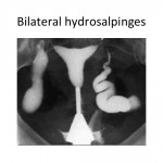 Bilateral hydrosalpinges