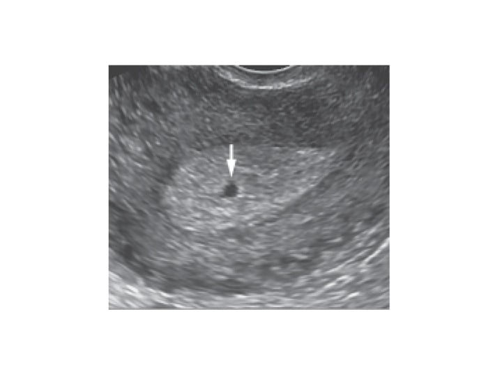 Gestational sac at 5 weeks gestation (arrow)