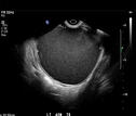 ovarian endometrioma ultrasound