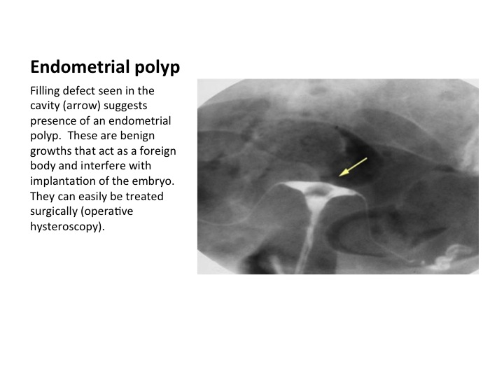 Commonly Seen Uterine Abnormalities on Hysterosalpingography (HSG)