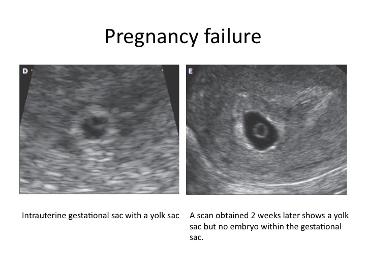 normal heartbeat of fetus