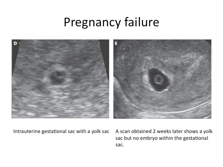 Abnormal Ultrasound in Early Pregnancy