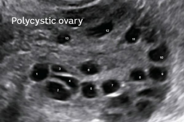 When And Why We Use Metformin To Help Manage Polycystic Ovary Syndrome can-metformin-help-with-weight-loss-dr-spencer-nadolsky