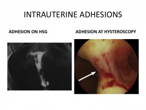adhesions in the uterus