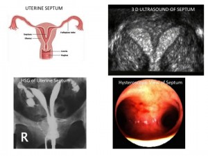 Four views of uterine septum