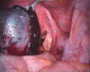 Endoscopic image of a ruptured endometrioma in the left ovary