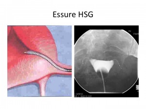 Essure_HSG.jpg