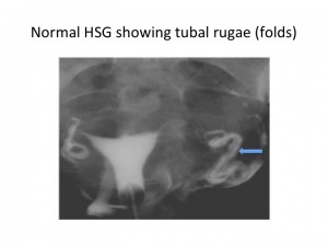 Hsg Image Normal Inverted Common Tubal Abnormalities Seen in Hysterosalpingography