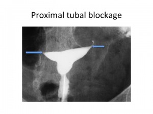 Proximal_tubal_blockage.jpg