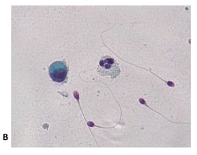 white-blood-cells-in-semen-2.jpg