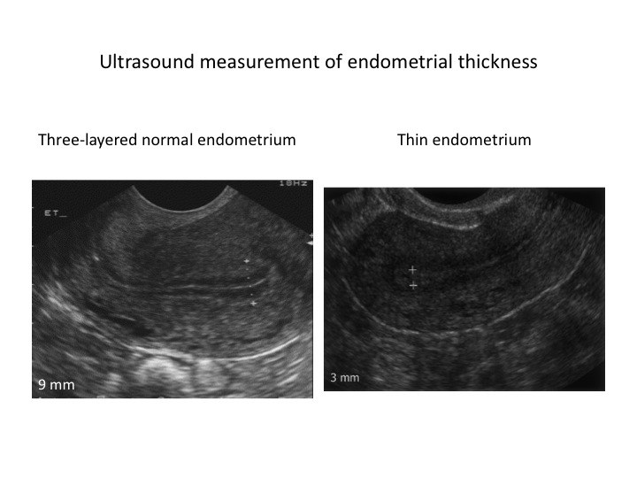 Thickness what is abnormal? endometrial Significance of