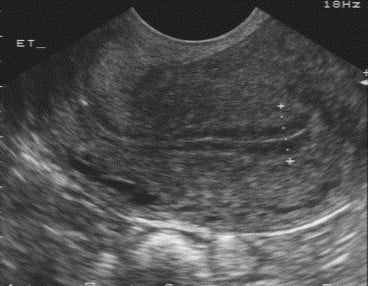 Endometrial Lining Thickness Chart