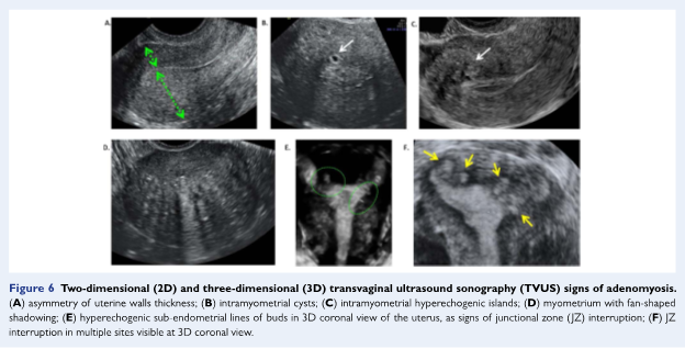 adenomyosis on ultrasound