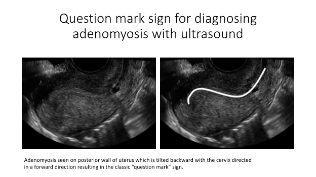 adenomyosis question mark