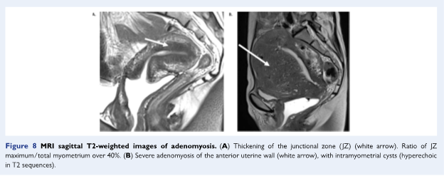 adenomyosis MRI image